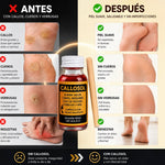 CALLOSOL | Elimina Callos, Verrugas y Más.
