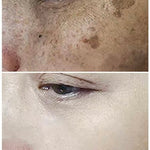 Eliminador de Manchas y Pecas SADOER™ | Niacinamida + Vitamina C